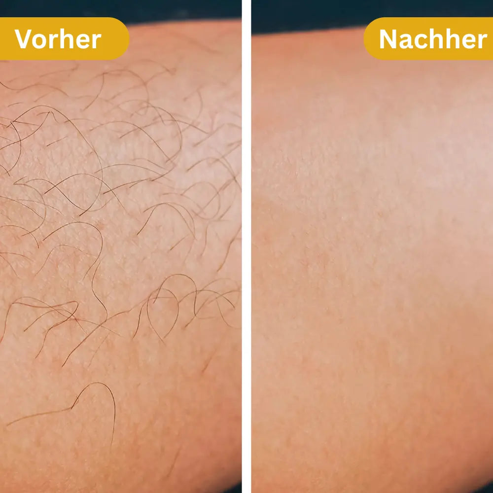 Hair-Away | Schnelle und effektive Haarentfernung (1+1 GRATIS Aktion)